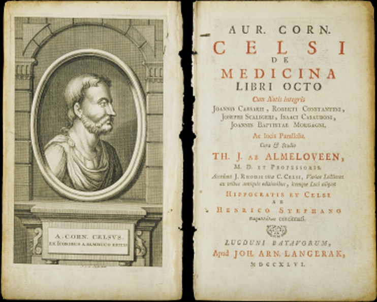 上图:塞尔苏斯(Aulus Cornelius Celsus,主前25-主后50年)编纂的百科全书《医术 De Medicina》。在这本书中提到希腊文称为elephantiasis graecorum的疾病,症状与现代的麻风病相似。但主前3-2世纪的希腊文七十士译本却把「大麻风 ???????」译为Λ?πρα(lepra),意思是「使皮肤有鳞的病」。主后5世纪耶柔米(Jerome)在翻译拉丁文武加大译本时,也没有使用学名elephantiasis graecorum,而是使用lepra的音译,表明他并不认为lepra就是麻风病,而只是一种恶性皮肤病。从lepra转变来的英文leprosy,后来被用来称呼「麻风病 Hansen's Disease」。